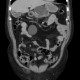 Pancreatic pseudocyst, pseudocyst in mesentery: CT - Computed tomography